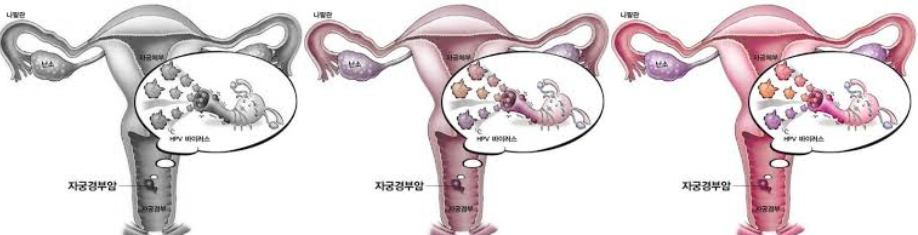 자궁경부암에 대해서